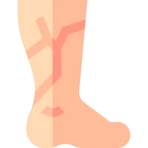 Varicose veins and swelling